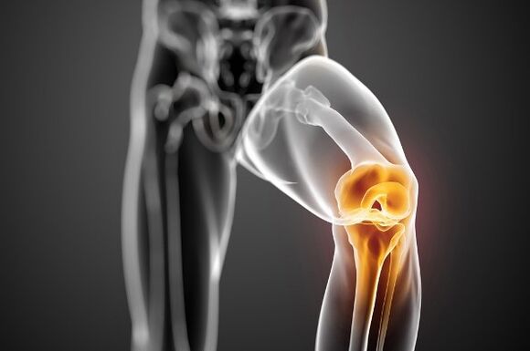Arthrosis of the knee joint
