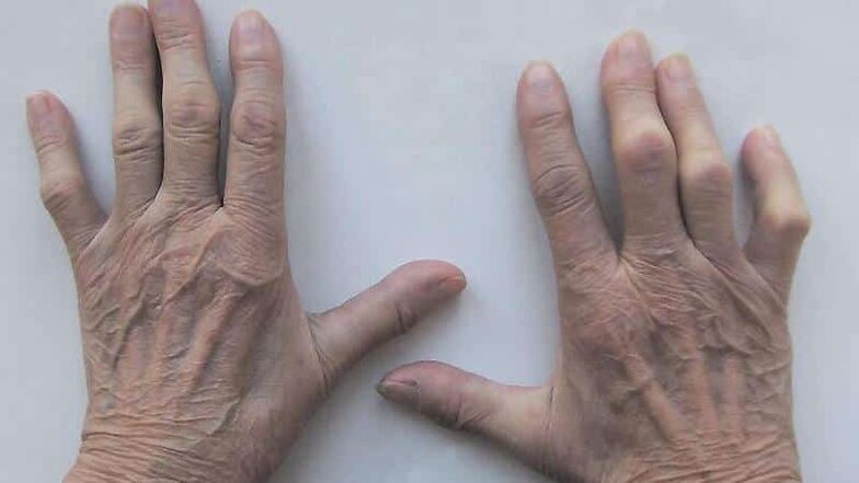 Methods for treating pain in the finger joint