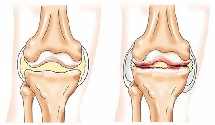 Joint and healthy joints affected by arthrosis