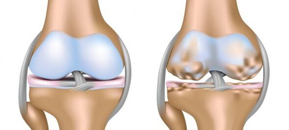Cartilage and healthy cartilage affected by arthrosis