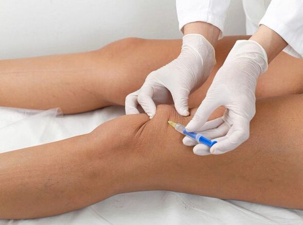 intra-articular injection for knee arthrosis