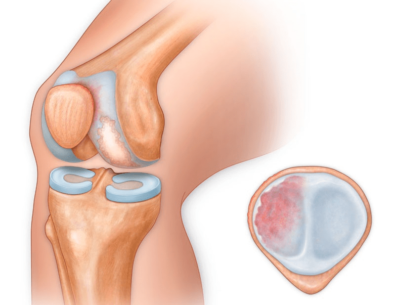 What does knee arthrosis look like