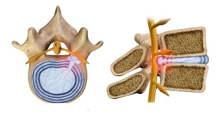 Intervertebral disc herniation - protrusion of the disc nucleus into the spinal canal